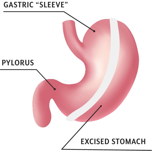 Gastric Sleeve Weight Loss Surgery in Orange & Los Angeles County