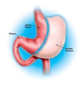 gastric sleeve operation