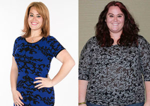gastric sleeve patient before after photo