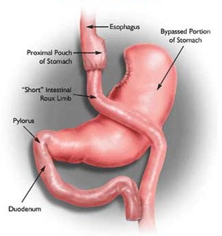 gastric bypass operation